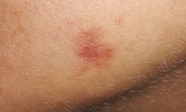 Infiammazione post rimozione chirurgica cisti sebacea - 58586