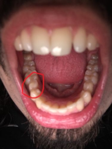 Ruotare Dente con INVISALIGN