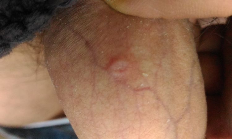 Sifilide? Cicatrice asta pene - 59229
