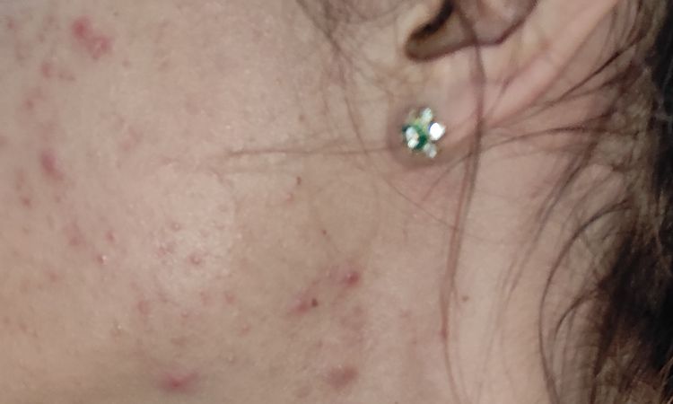 Acne durante e post covid - 59244