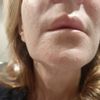 Mento plastica riduttiva lato destro della bocca inferiore bloccata e storta - 59472