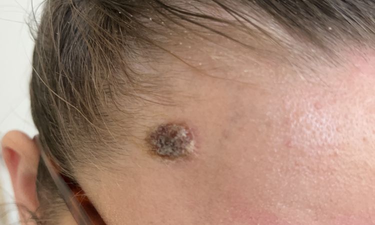 Cauterizzazione angioma - 59497