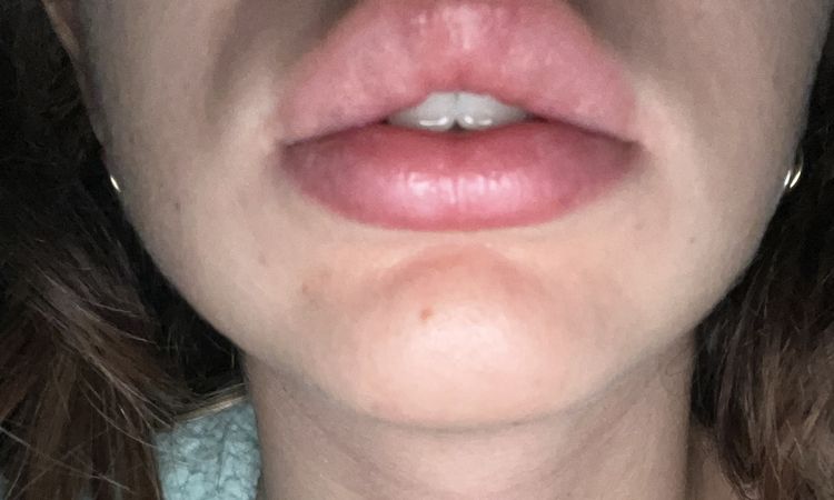 Seduta di lipfiller e granuli - 59523