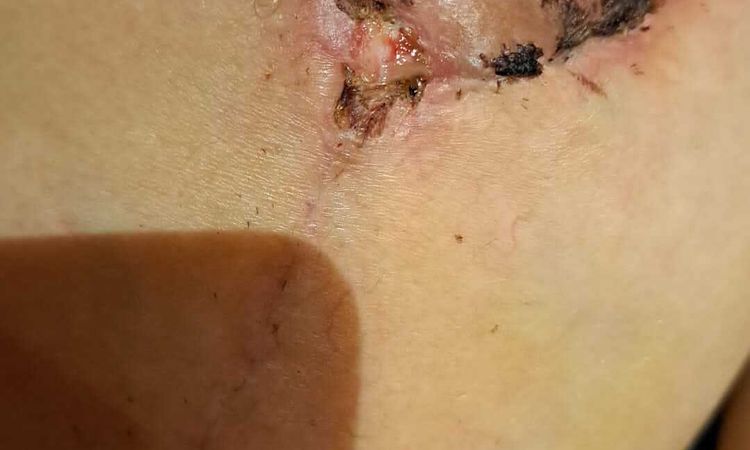Mastopessi con Cambio protesi e riduzione del seno - 60208
