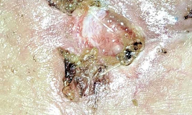 Mastopessi con Cambio protesi e riduzione del seno - 60209