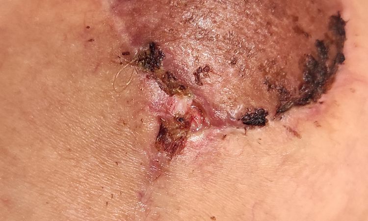 Mastopessi con Cambio protesi e riduzione del seno - 60210