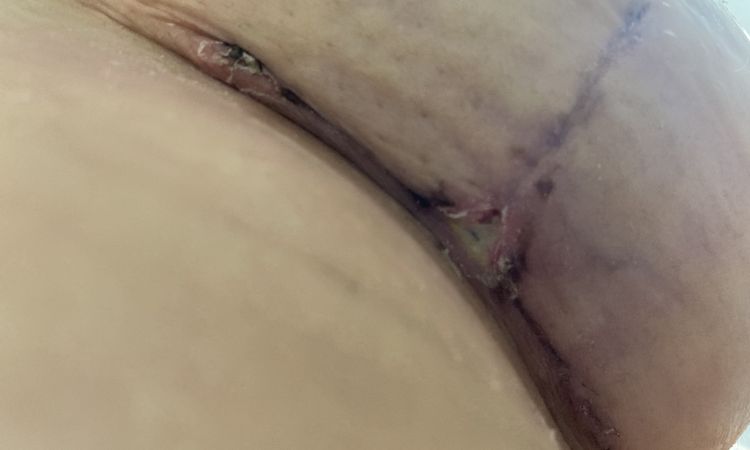 Ferita riaperta Mastopessi! - 60411
