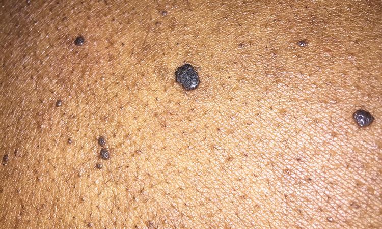 Info neo oppure melanoma sulla schiena? - 60434