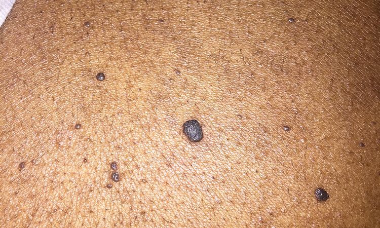 Info neo oppure melanoma sulla schiena? - 60435