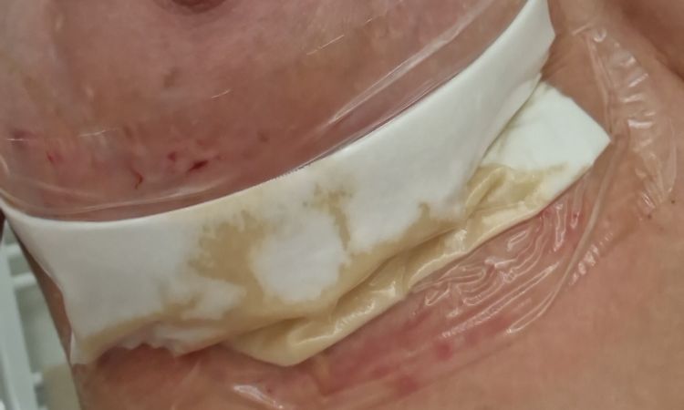 Deiscenza mastoplastica - 60559