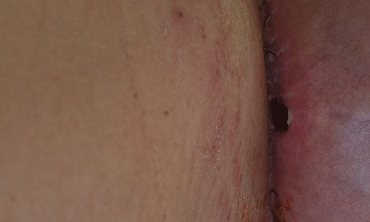 Deiscenza mastoplastica - 60560