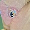 Lacerazione post mastoplastica additiva