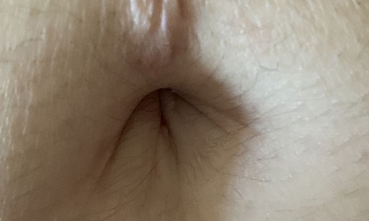 Pelle "non aderente" cicatrice piercing, come risolvere? - 60804