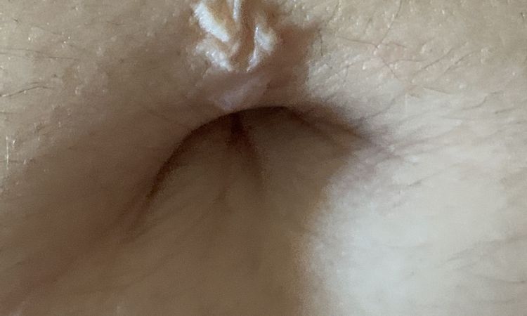 Pelle "non aderente" cicatrice piercing, come risolvere? - 60805