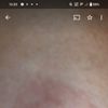 Come rimediare ad una cicatrice dell'areola post mastoplastica