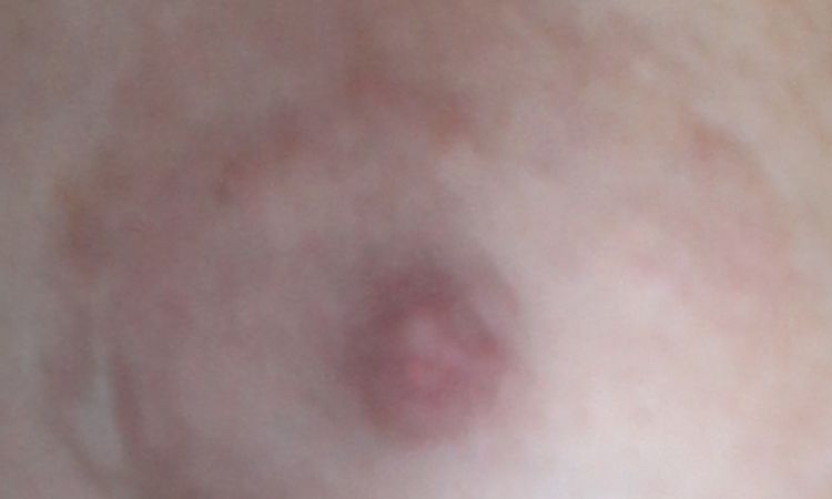 Come rimediare ad una cicatrice dell'areola post mastoplastica - 60844