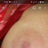 Come rimediare ad una cicatrice dell'areola post mastoplastica