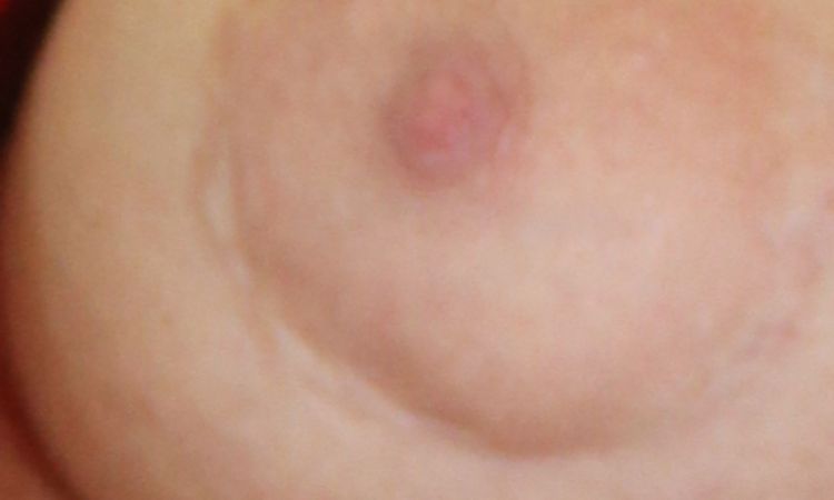 Come rimediare ad una cicatrice dell'areola post mastoplastica - 60845