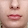 Diverso riassorbimento filler tra labbro superiore e inferiore