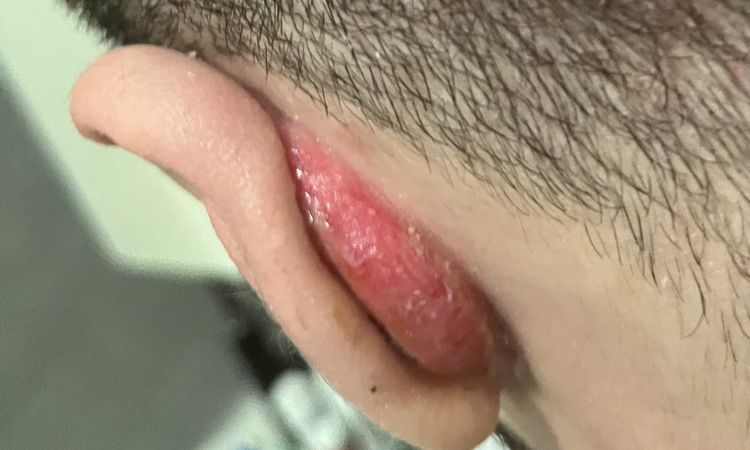 Cheloidi post Otoplastica - Cura con Crioterapia - 61327