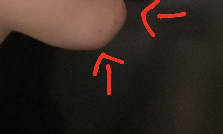 Sporgenza nel mento dopo lipofilling - 61484
