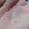 Segno viola rosso dolorante sul palmo della mano