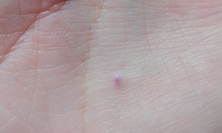 Segno viola rosso dolorante sul palmo della mano - 61778