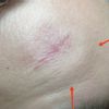 Gonfiore sottocutaneo post asportazione lipoma
