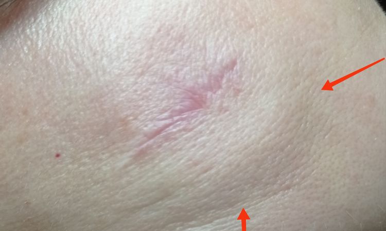 Gonfiore sottocutaneo post asportazione lipoma - 62097