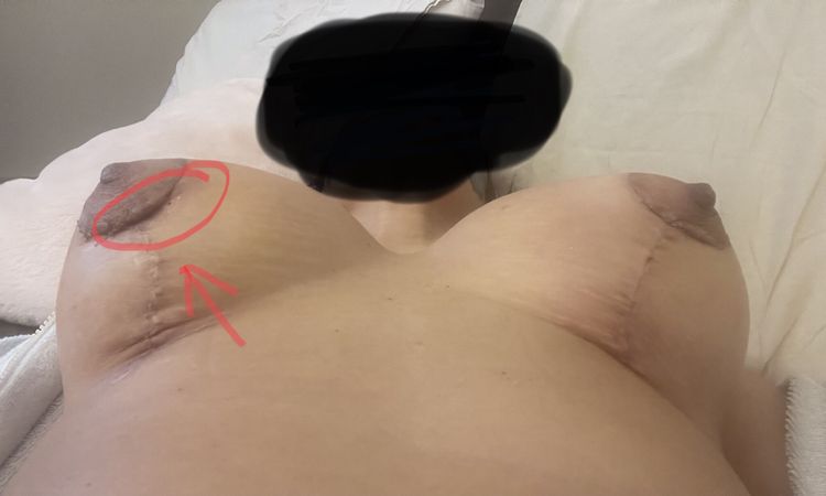 Mastopessi con protesi, cicatrice areola - 62288