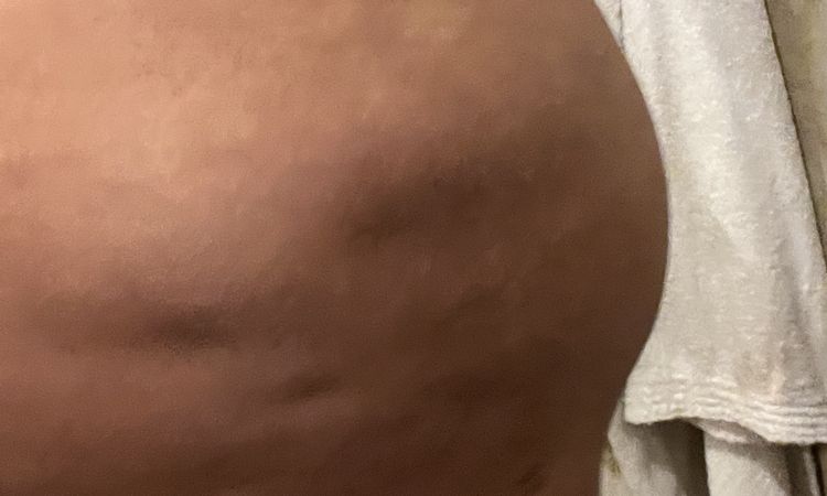 Correzione Liposcultura. - 63346