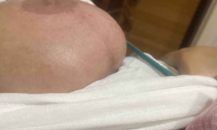 Mastopessi con protesi: ferite infette e seno arrossato - 63427