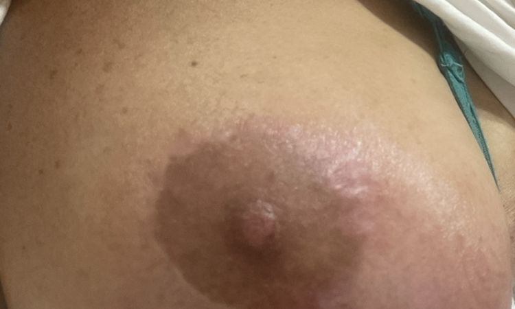 Mastopessi con protesi: ferite infette e seno arrossato - 63428