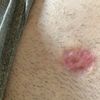 Pelle raggrinzita dopo iniezioni lidodepromedrol