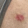 Pelle raggrinzita dopo iniezioni lidodepromedrol