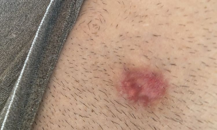 Pelle raggrinzita dopo iniezioni lidodepromedrol - 64095