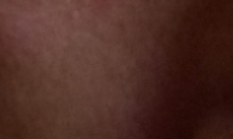 Post trattamento angioma con laser neodimio yag - peggioramento - 64466