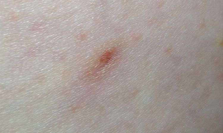 Danni post laser capillari ND-YAG Deka. - 64920