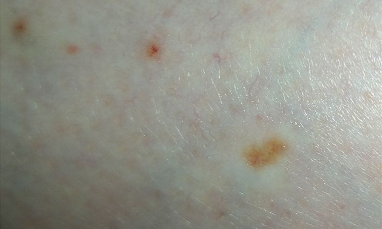 Danni post laser capillari ND-YAG Deka. - 64921