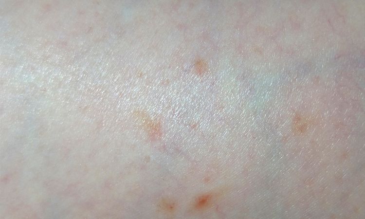 Danni post laser capillari ND-YAG Deka. - 64922