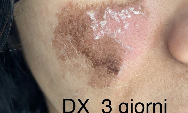 Peeling chimico: a 17gg macchie come “da ustione” - 65047