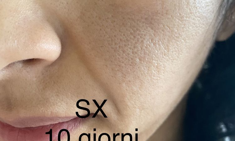 Peeling chimico: a 17gg macchie come “da ustione” - 65051