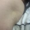 Carbossiterapia cellulite e infossamento
