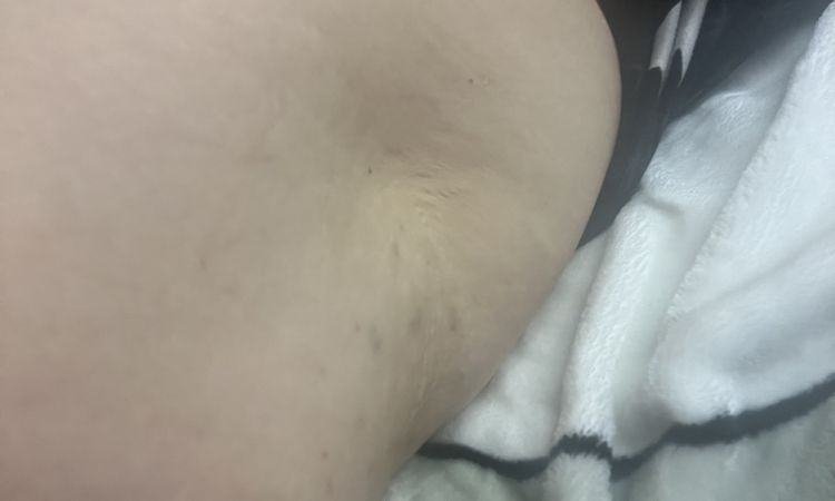 Carbossiterapia cellulite e infossamento - 65083