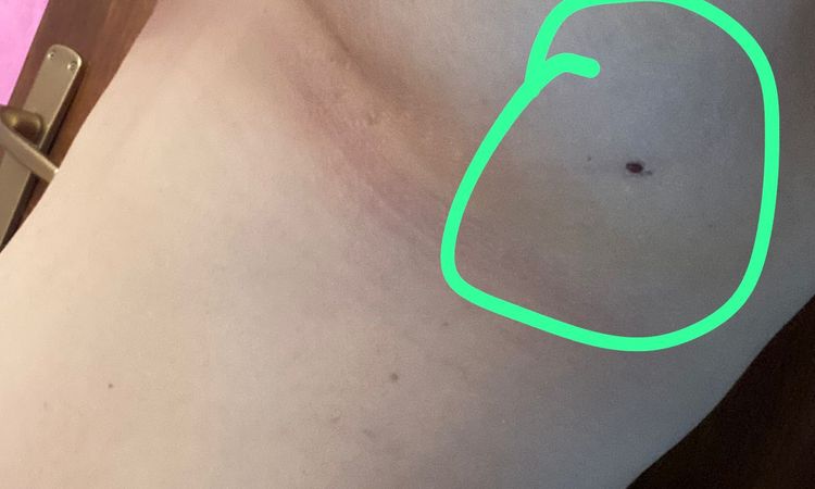 Un mese post mastoplastica. Protesi mal posizionata? - 65091