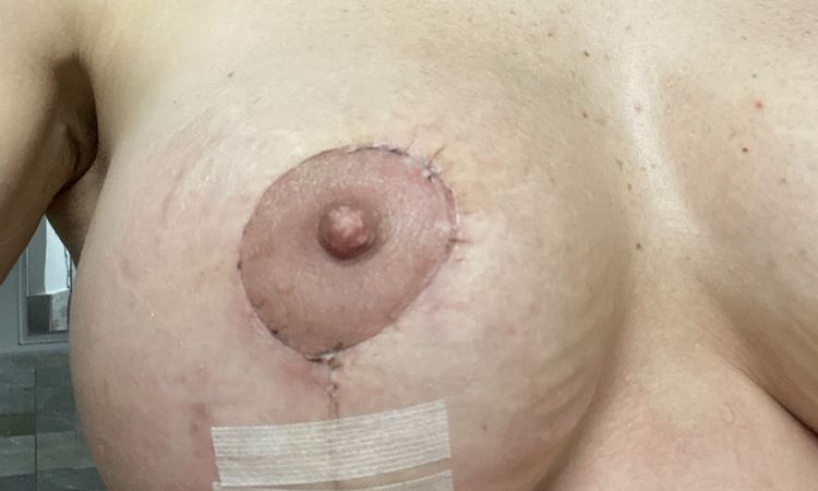 Areola irregolare dopo inserimento protesi - 65330