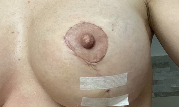 Areola irregolare dopo inserimento protesi - 65332