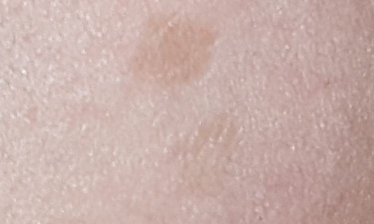 Melasma e macchie scure - 65506