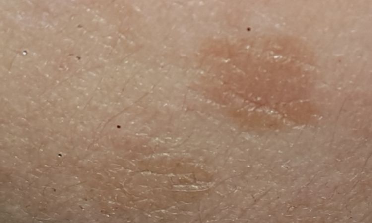 Melasma e macchie scure - 65507