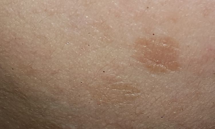 Melasma e macchie scure - 65508